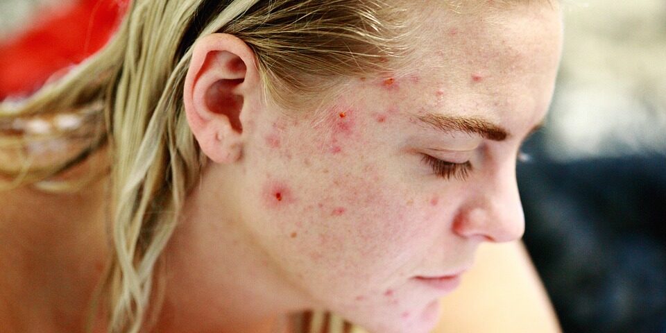 i segni dell’acne