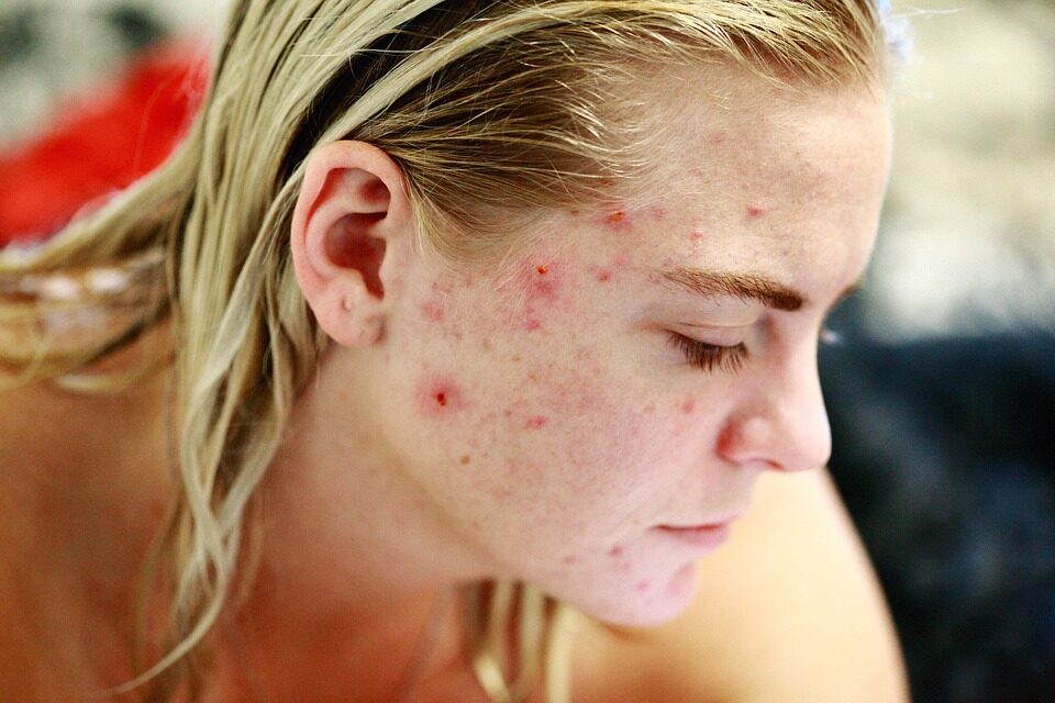 i segni dell’acne